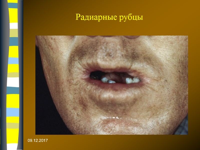 Радиарные рубцы  09.12.2017